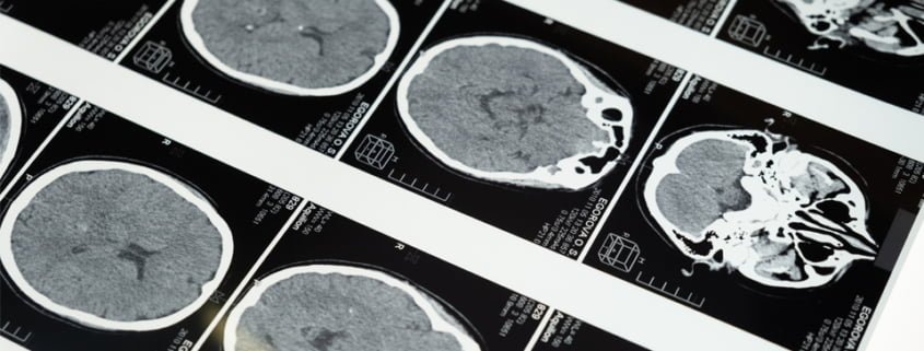 Çocuklarda Pediatrik Multiple Skleroz (MS)